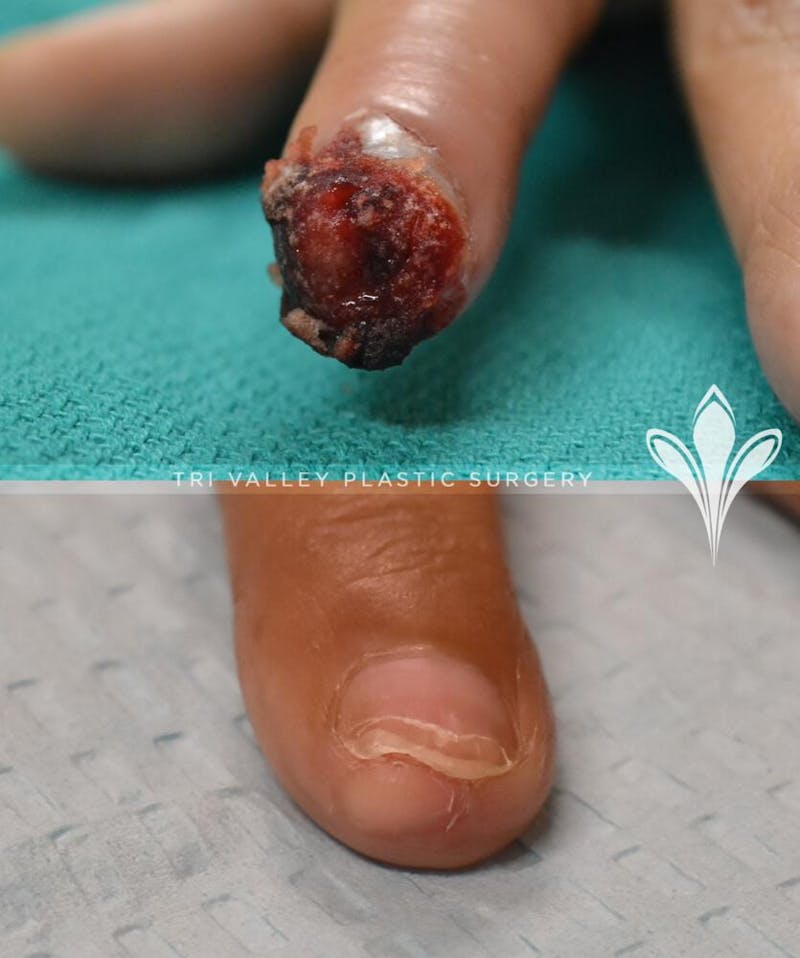 Reconstructive Before & After Gallery - Patient 191404904 - Image 2