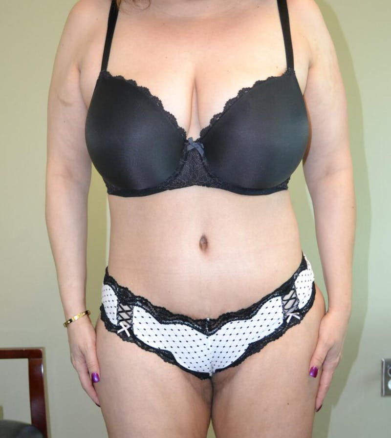 Tummy Tuck Before & After Gallery - Patient 191404903 - Image 2