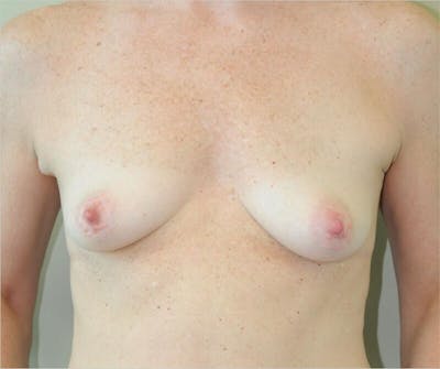 Breast Augmentation Before & After Gallery - Patient 191404911 - Image 1