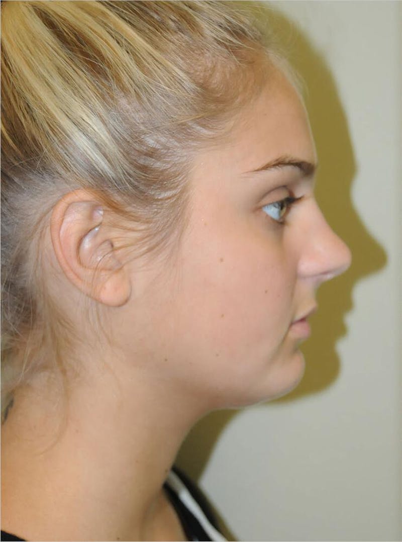 Liposuction Before & After Gallery - Patient 191404907 - Image 3