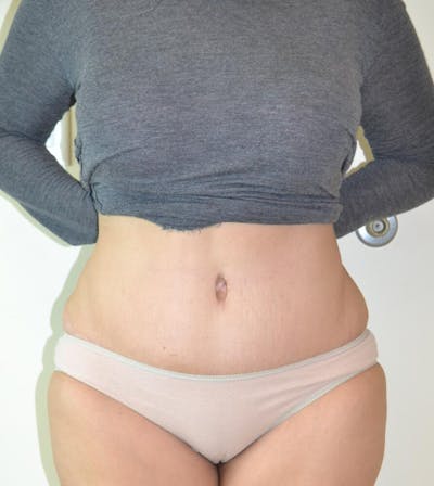 Tummy Tuck Before & After Gallery - Patient 191404906 - Image 2