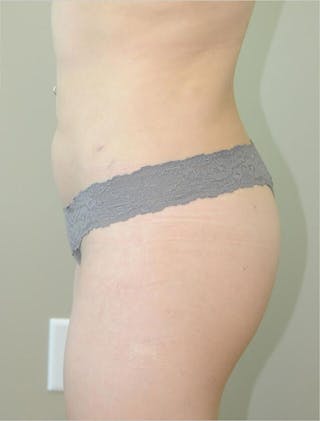 Brazilian Butt Lift Before & After Gallery - Patient 191404908 - Image 6