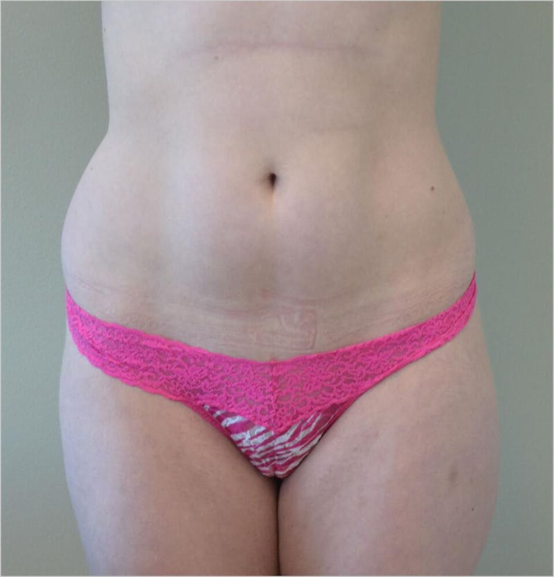Liposuction Before & After Gallery - Patient 191404948 - Image 1