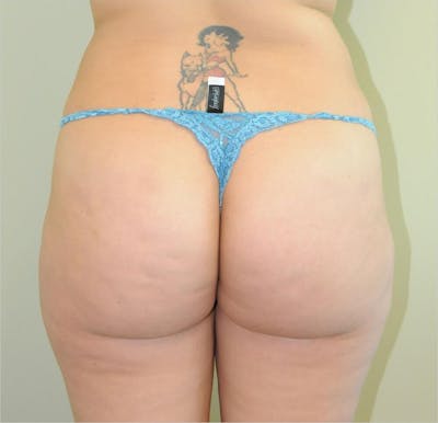 Brazilian Butt Lift Before & After Gallery - Patient 191404953 - Image 1