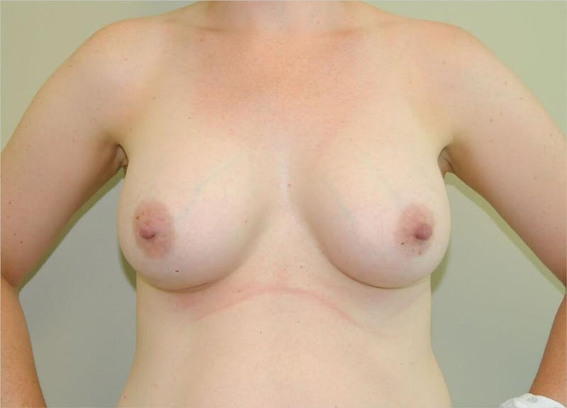 Breast Augmentation Before & After Gallery - Patient 191404956 - Image 2
