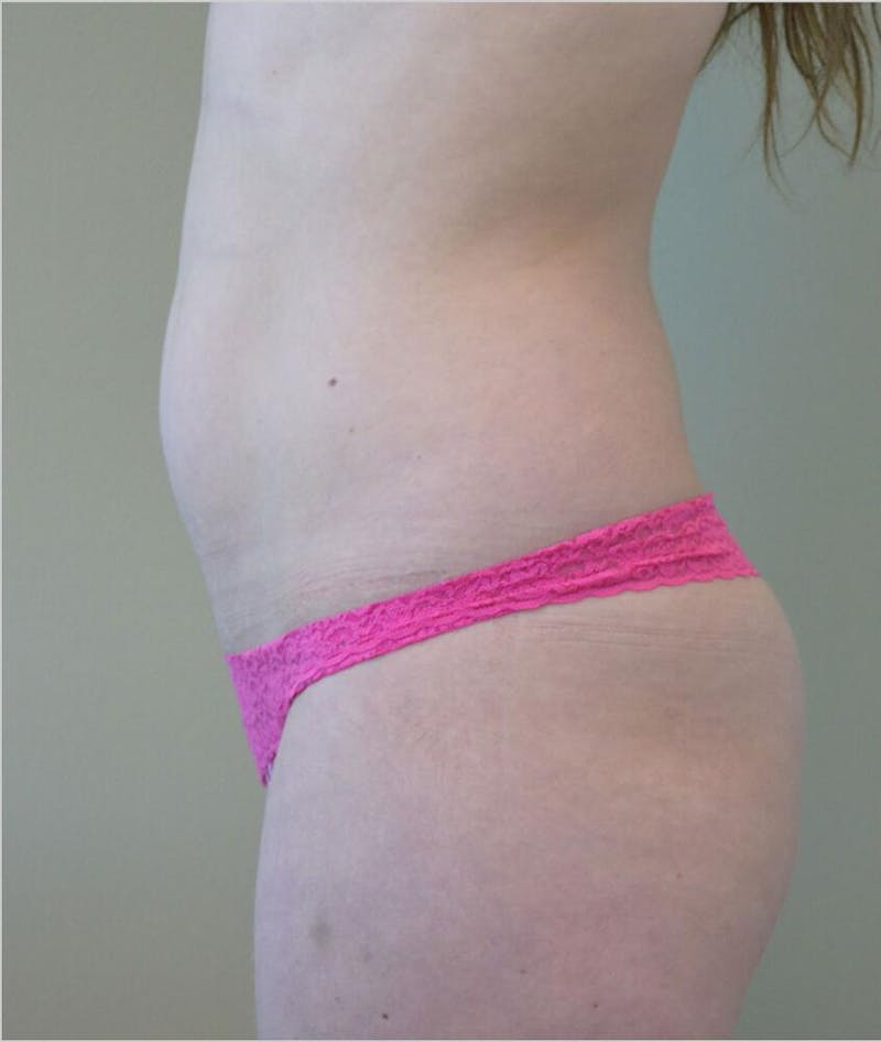 Liposuction Before & After Gallery - Patient 191404948 - Image 5