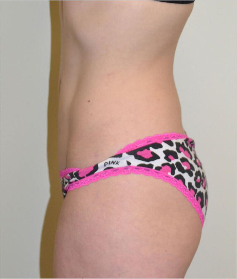 Liposuction Before & After Gallery - Patient 191404948 - Image 6