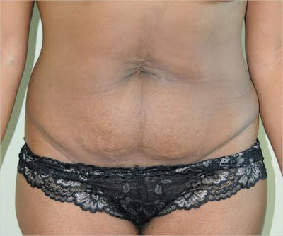 Liposuction Before & After Gallery - Patient 191404972 - Image 1