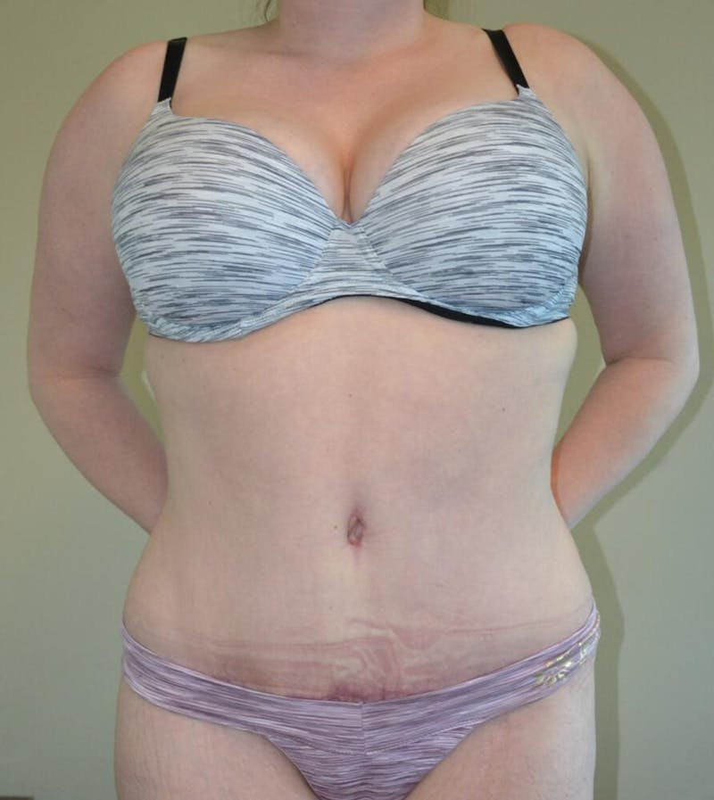 Tummy Tuck Before & After Gallery - Patient 191404957 - Image 2