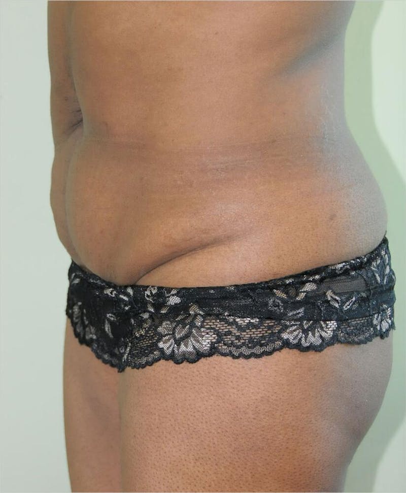 Liposuction Before & After Gallery - Patient 191404972 - Image 3