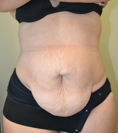 Tummy Tuck Before & After Gallery - Patient 191404980 - Image 1