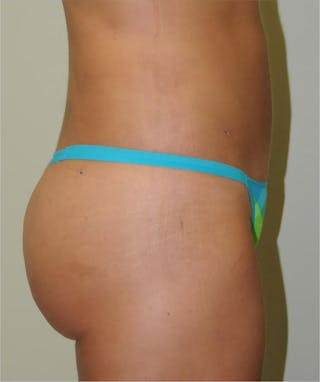 Brazilian Butt Lift Before & After Gallery - Patient 191404963 - Image 4