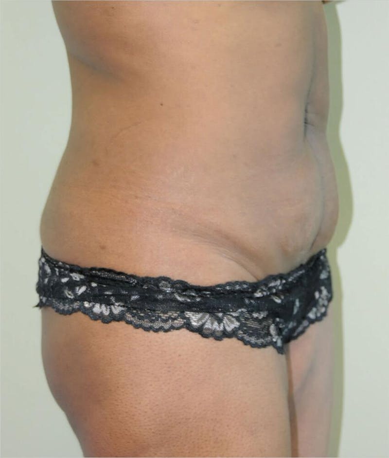 Liposuction Before & After Gallery - Patient 191404972 - Image 5