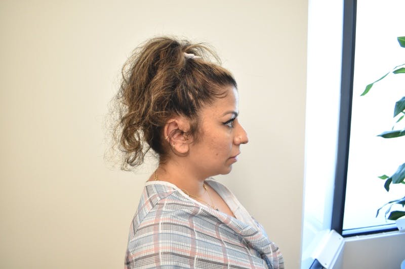 Chin Augmentation Before & After Gallery - Patient 191405031 - Image 3