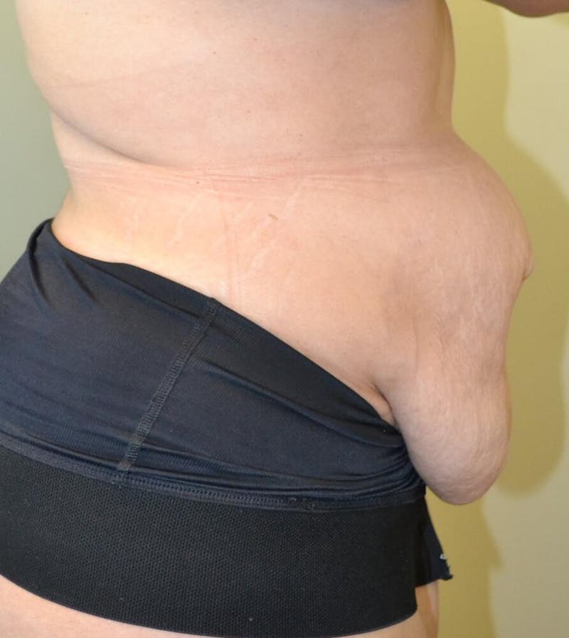 Tummy Tuck Before & After Gallery - Patient 191404980 - Image 3