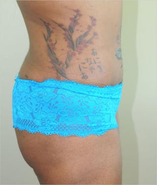 Liposuction Before & After Gallery - Patient 191404972 - Image 6