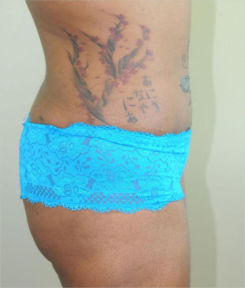Liposuction Before & After Gallery - Patient 191404972 - Image 6