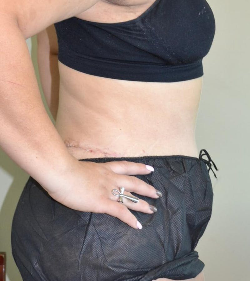 Tummy Tuck Before & After Gallery - Patient 191404980 - Image 4