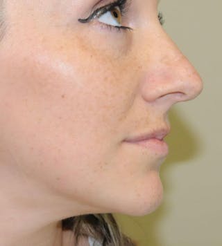 Rhinoplasty Before & After Gallery - Patient 191405030 - Image 2