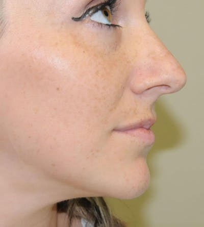 Rhinoplasty Before & After Gallery - Patient 191405030 - Image 1