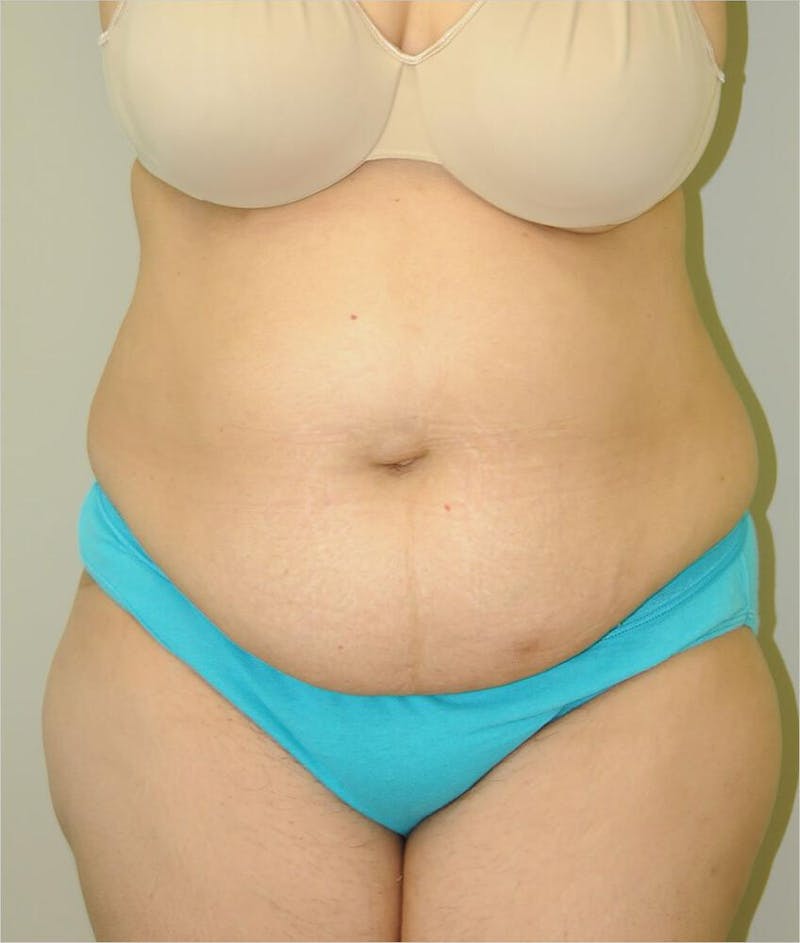 Liposuction Before & After Gallery - Patient 191405033 - Image 1