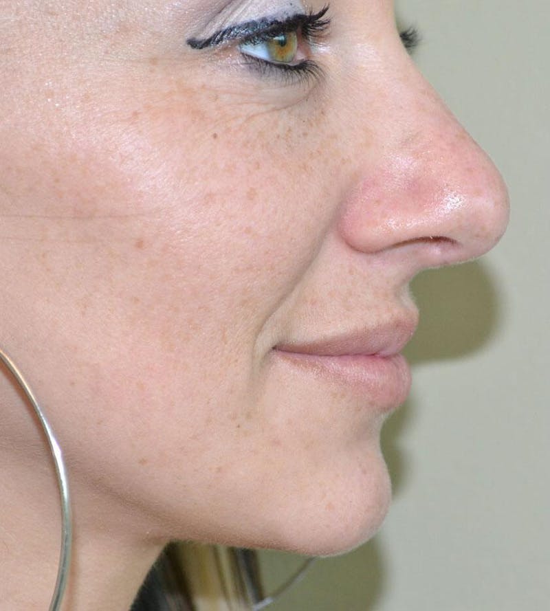 Rhinoplasty Before & After Gallery - Patient 191405030 - Image 2