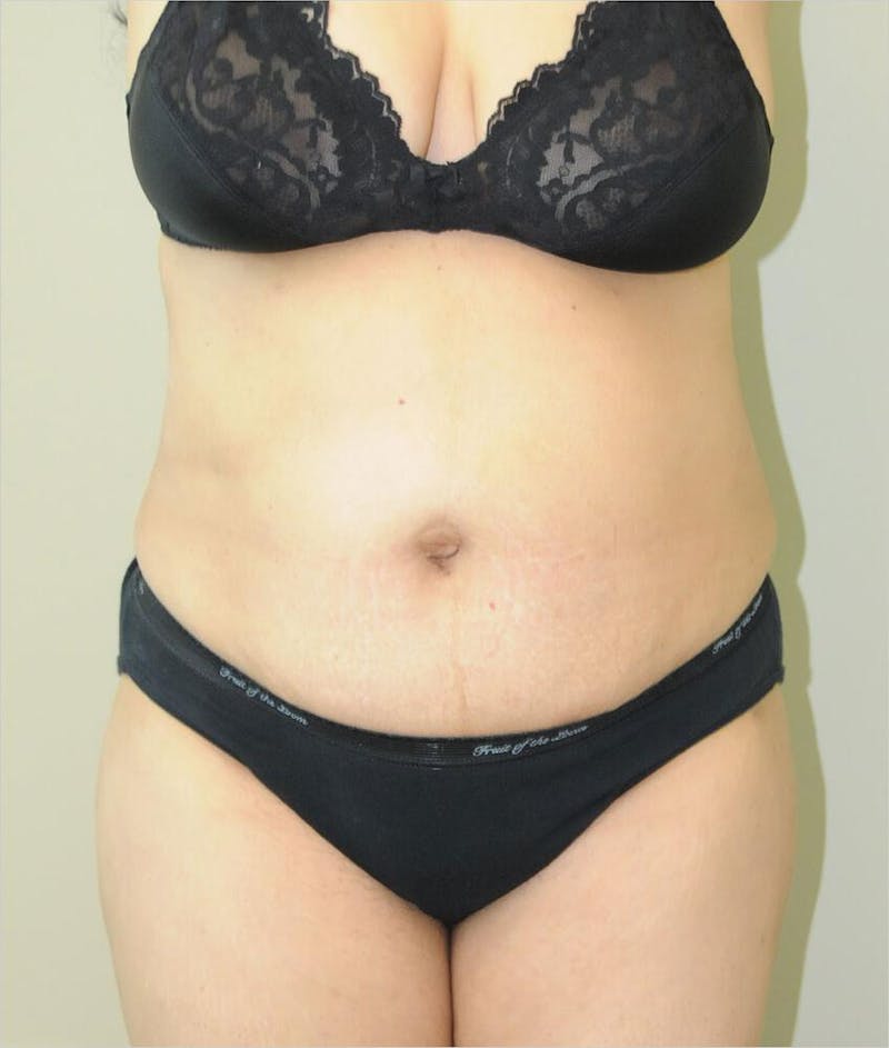 Liposuction Before & After Gallery - Patient 191405033 - Image 2