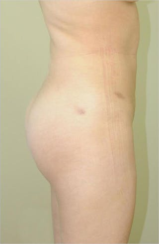 Brazilian Butt Lift Before & After Gallery - Patient 191404989 - Image 4
