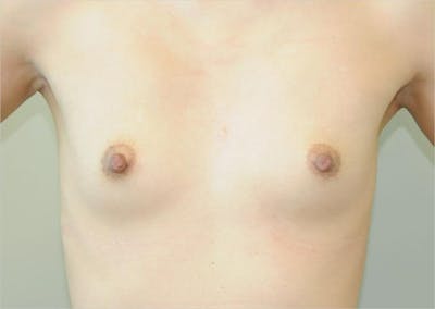 Breast Augmentation Before & After Gallery - Patient 191405034 - Image 1