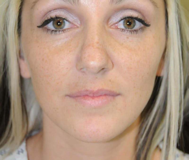 Rhinoplasty Before & After Gallery - Patient 191405030 - Image 3