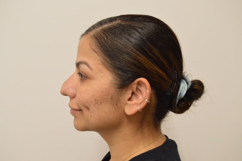 Chin Augmentation Before & After Gallery - Patient 191405031 - Image 6