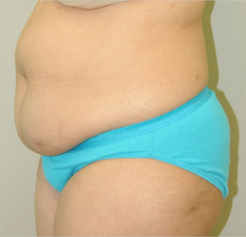 Liposuction Before & After Gallery - Patient 191405033 - Image 3