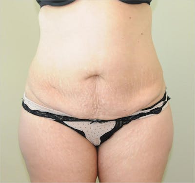 Tummy Tuck Before & After Gallery - Patient 191405035 - Image 1