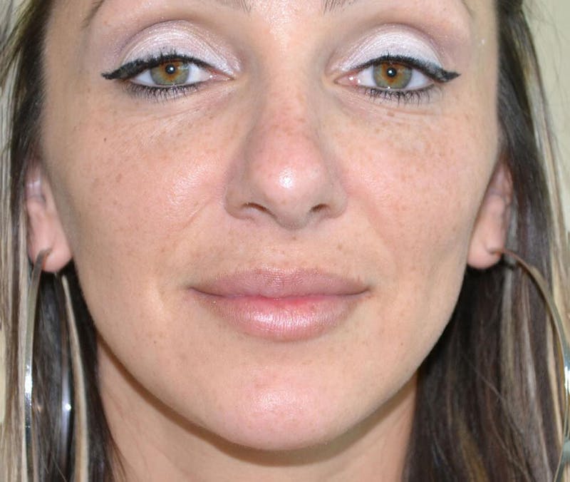 Rhinoplasty Before & After Gallery - Patient 191405030 - Image 4