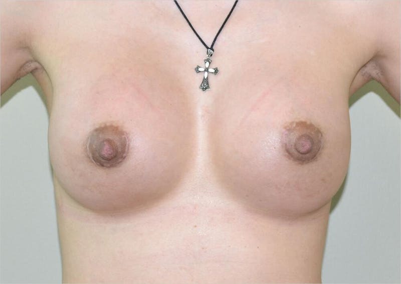 Breast Augmentation Before & After Gallery - Patient 191405034 - Image 2