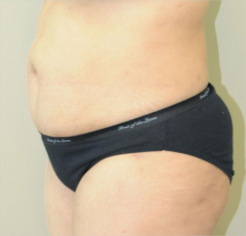 Liposuction Before & After Gallery - Patient 191405033 - Image 4
