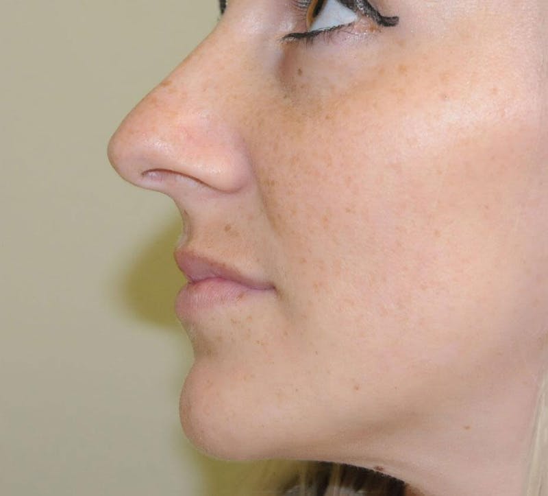 Rhinoplasty Before & After Gallery - Patient 191405030 - Image 5