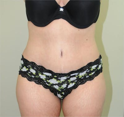 Tummy Tuck Before & After Gallery - Patient 191405035 - Image 2