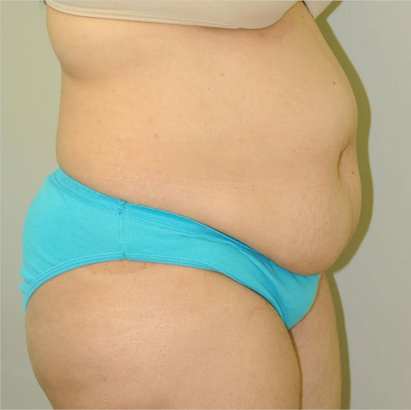 Liposuction Before & After Gallery - Patient 191405033 - Image 5