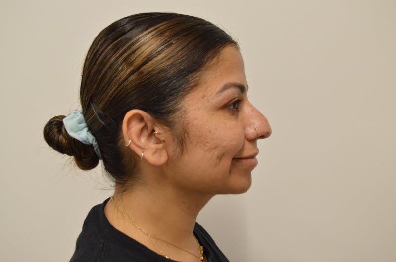 Chin Augmentation Before & After Gallery - Patient 191405031 - Image 8