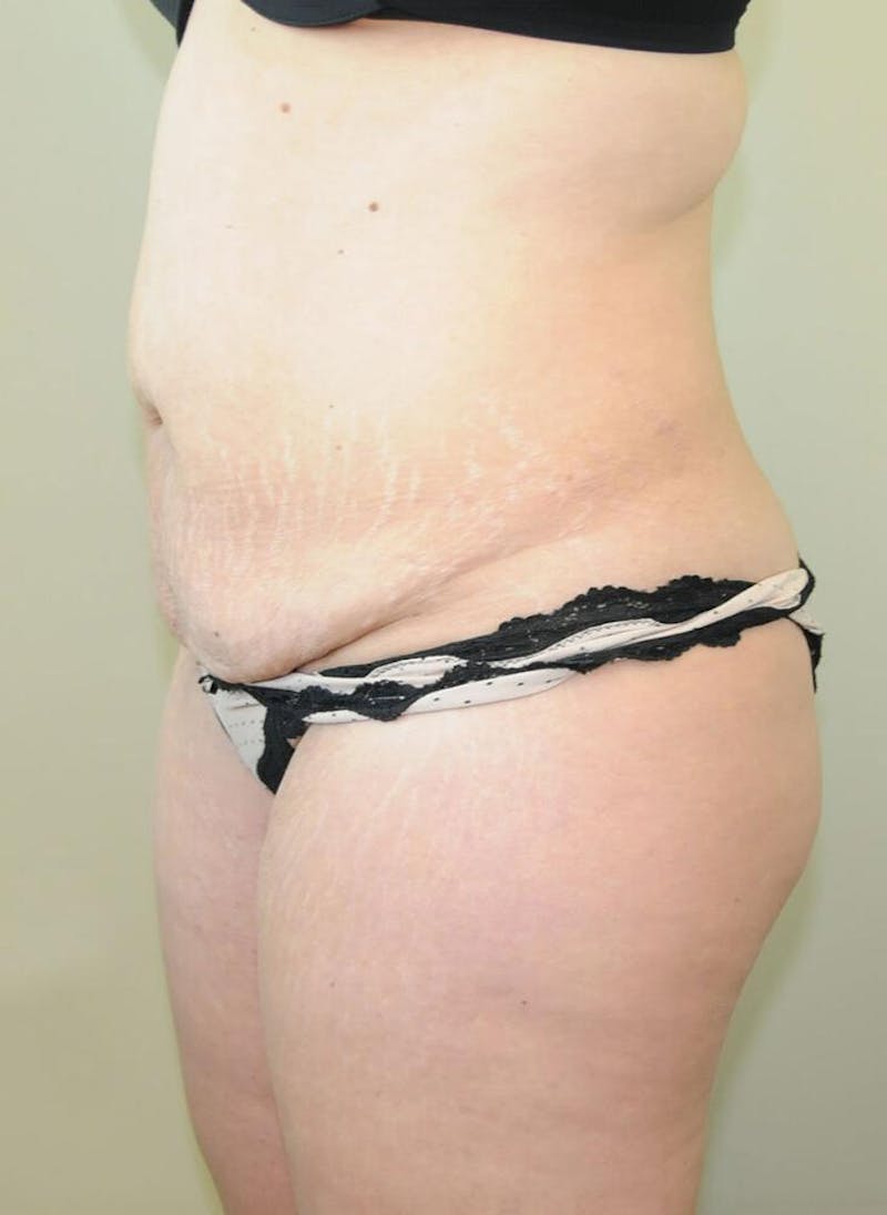 Tummy Tuck Before & After Gallery - Patient 191405035 - Image 3