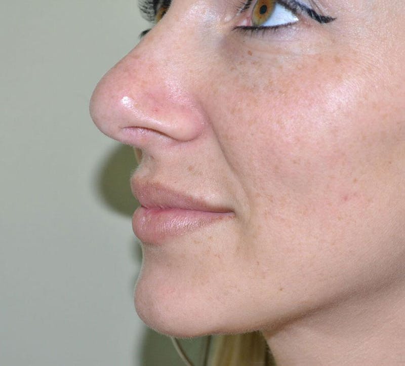 Rhinoplasty Before & After Gallery - Patient 191405030 - Image 6