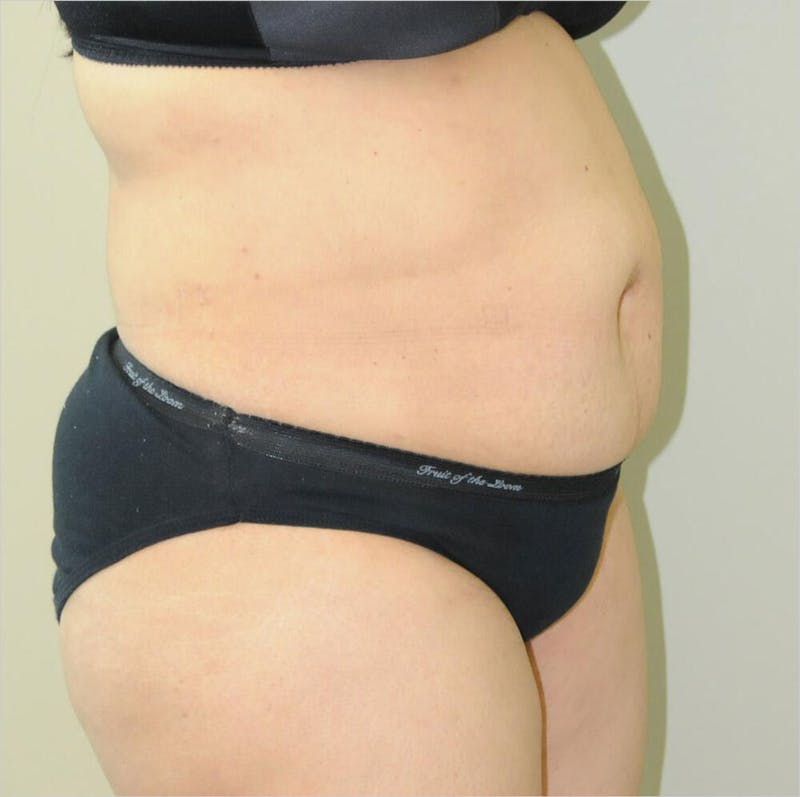 Liposuction Before & After Gallery - Patient 191405033 - Image 6