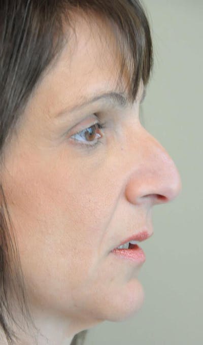 Rhinoplasty Before & After Gallery - Patient 191405039 - Image 1