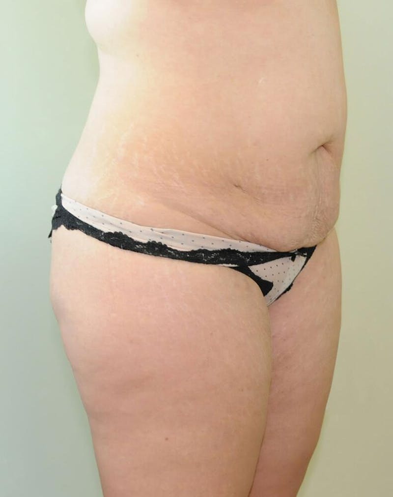 Tummy Tuck Before & After Gallery - Patient 191405035 - Image 5