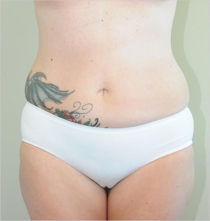 Liposuction Before & After Gallery - Patient 191405040 - Image 1