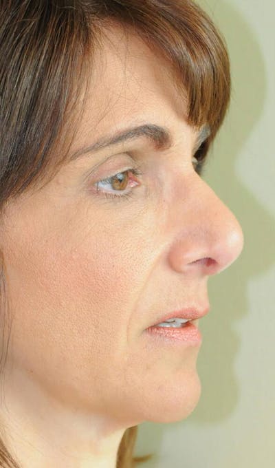 Rhinoplasty Before & After Gallery - Patient 191405039 - Image 2