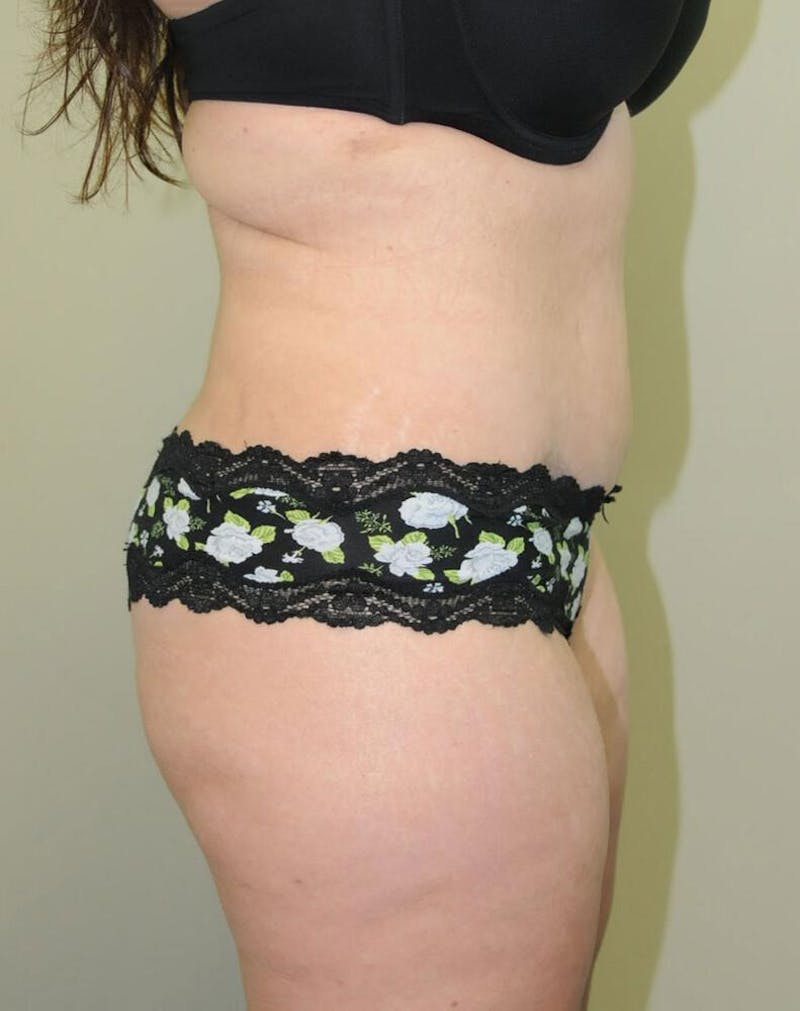 Tummy Tuck Before & After Gallery - Patient 191405035 - Image 6