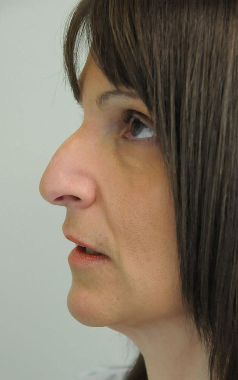 Rhinoplasty Before & After Gallery - Patient 191405039 - Image 3