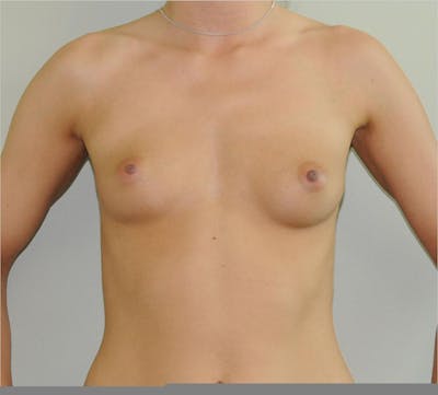 Breast Augmentation Before & After Gallery - Patient 191405041 - Image 1